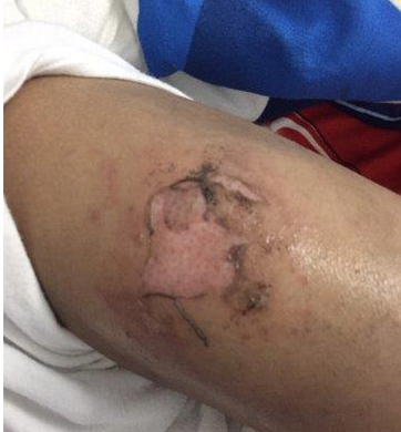 الجبيل: انفجار جوال في جيب طفل يتسبب له في حروق (صور)