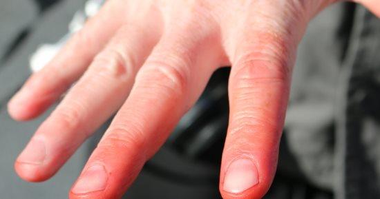 تعرّف على أعراض مرض 