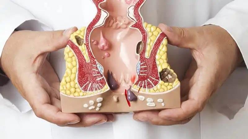 البواسير الخارجية البواسير الخارجية