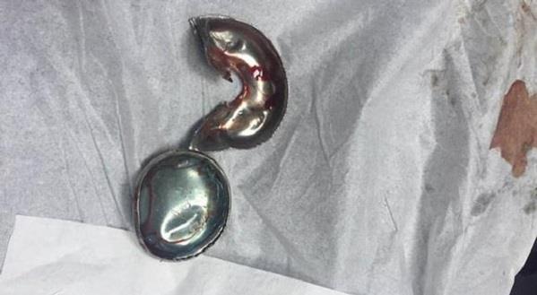 مدني المدينة يستخرج يد طفل محتجزه داخل صافرة قدر الضغط