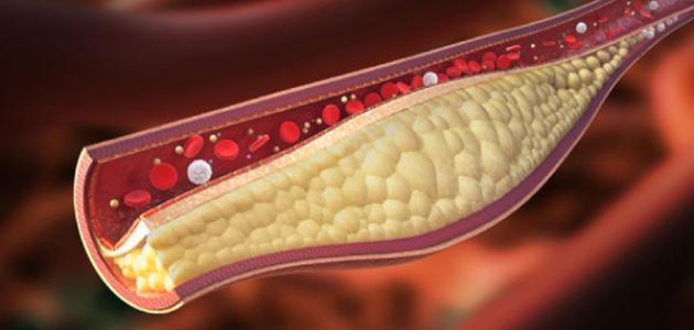  "استشاري": 7 نصائح لخفض الكوليسترول الضار قبل تناول الدواء 