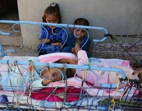 إجراء إحدى أصعب العمليات السيامية بفصل التوأم 