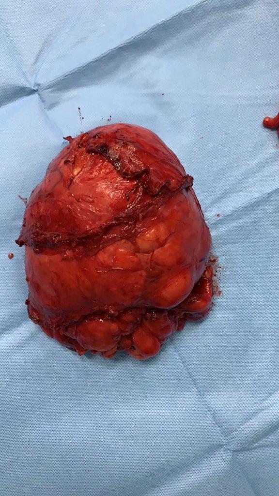 استئصال ورم بكيس الصفن يزن 2 كيلوجرام