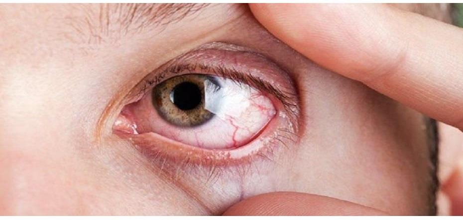 جفاف العيون