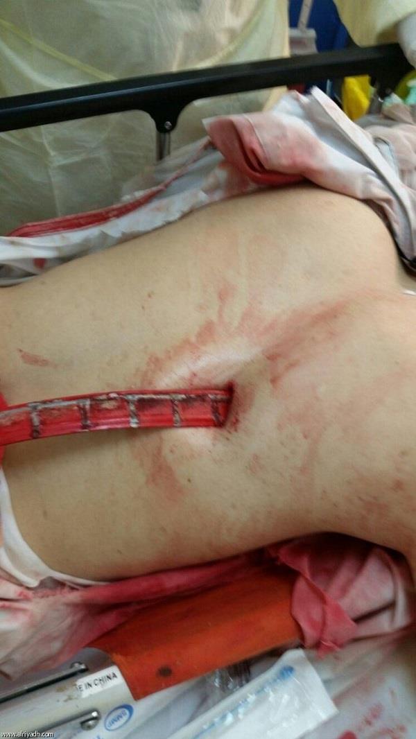 استخراج سيخ حديدي من ظهر مصاب في حادثة رافعة الحرم