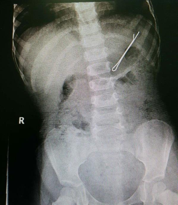 فريق طبي يستخرج مشبك شعر من معدة طفل ببريدة (صورة)