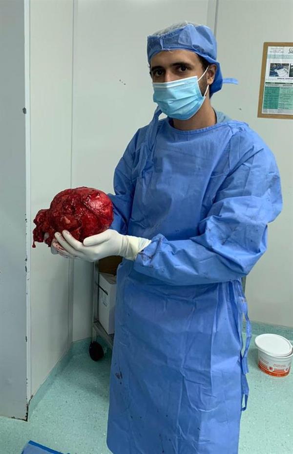 استئصال ورم بكيس الصفن يزن 2 كيلوجرام