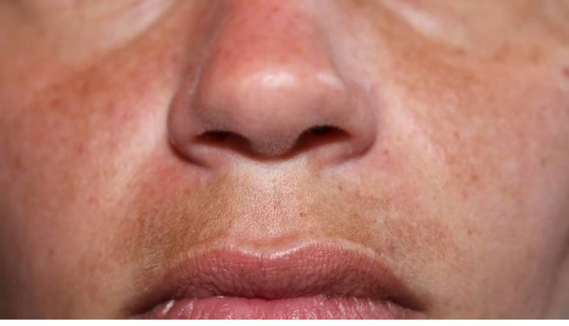 مشكلات البشرة