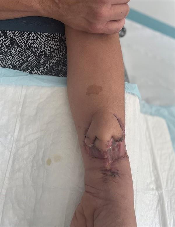  زراعة أنف بذراع 