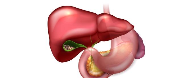 الوقاية من حصى المرارة