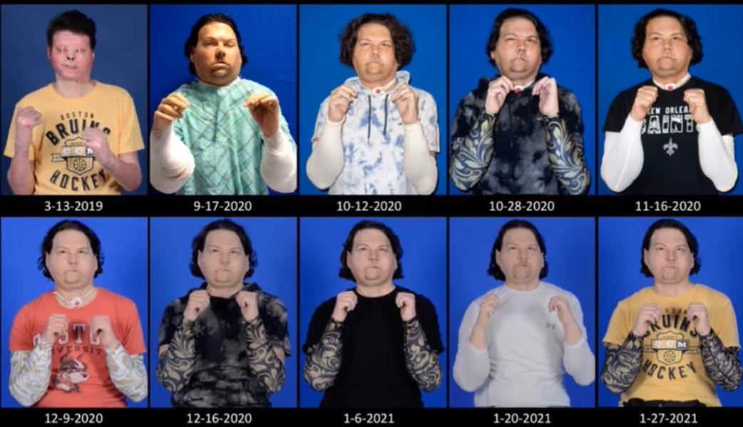 بمشاركة 96 كادرًا طبيًا .. نجاح زراعة وجه ويدين لشاب أمريكي (صور) بمشاركة 96 كادرًا طبيًا .. نجاح زراعة وجه ويدين لشاب أمريكي (صور)