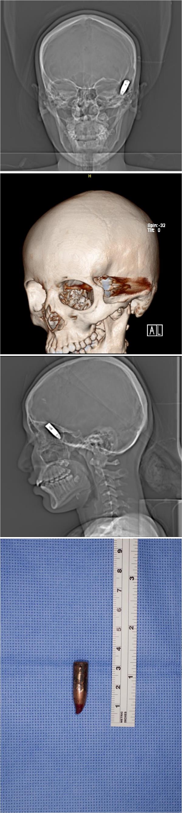 طلق ناري يخترق رأس فتاة طلق ناري يخترق رأس فتاة