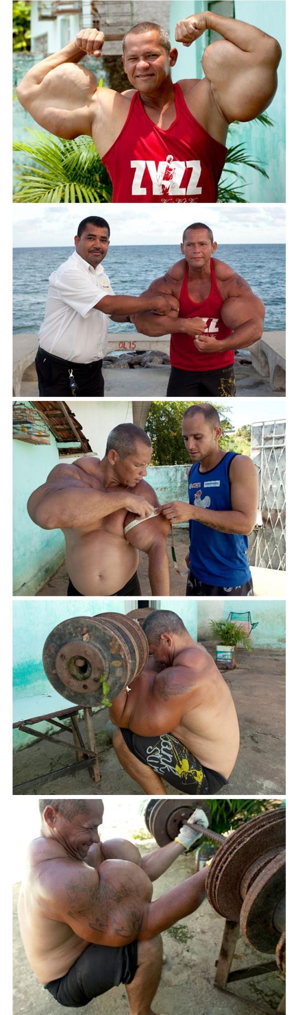برازيلي يحقن نفسه بخليط قاتل ليحصل على عضلات عملاقة