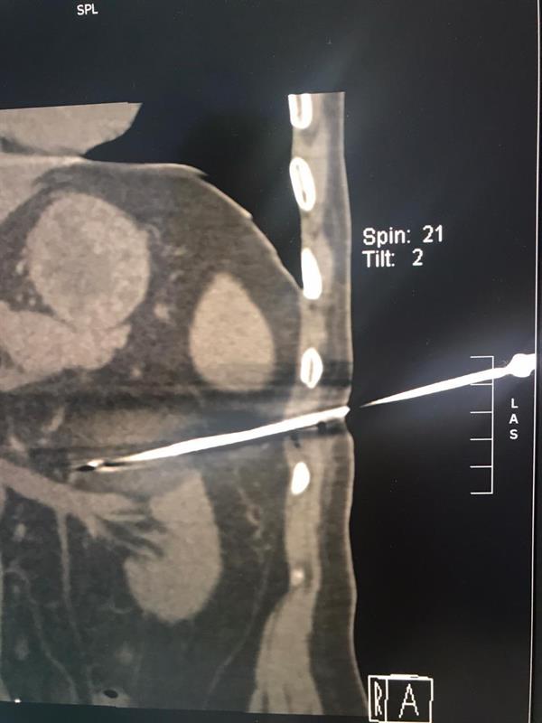 نجح فريق طبي بمدينة الملك عبدالله الطبية، من استئصال ورم سرطاني من الكلية اليسرى لمريض بالعقد السادس من العمر مع الحفاظ عليها وعلى وظيفتها بتقنية التبريد.  وأبانت مدينة الملك عبدالله الطبية، أن العملية تعد الأولى من نوعها على مستوى المنطقة الغربية، كما جرى تطبيق كافة الإجراءات الاحترازية الوقائية.