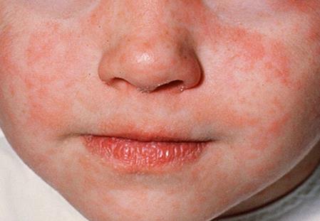 الحصبه الحصبه