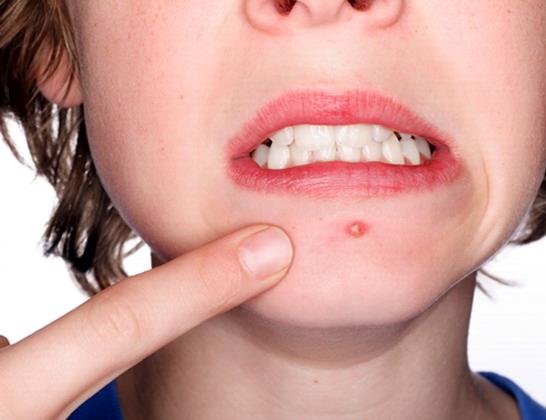 البثور البثور