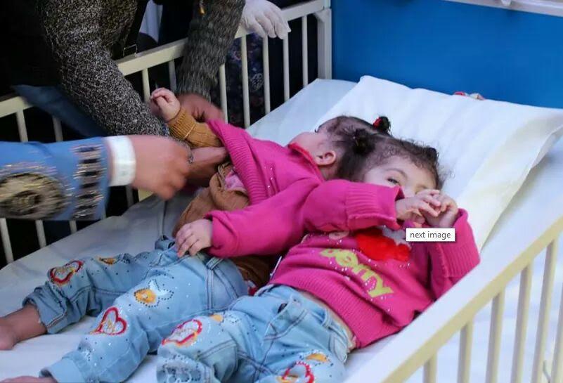 بالصور.. التوأم السيامي المصري تصلان إلى مستشفى الحرس الوطني والربيعة يطمئن عليهما