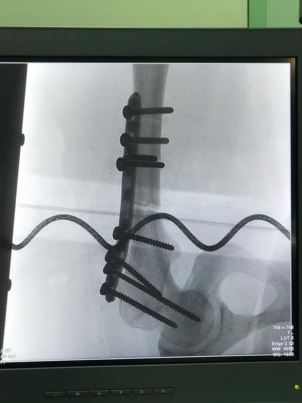 نجاح جراحة معقدة لحالتين تعانيان مرض نجاح جراحة معقدة لحالتين تعانيان مرض