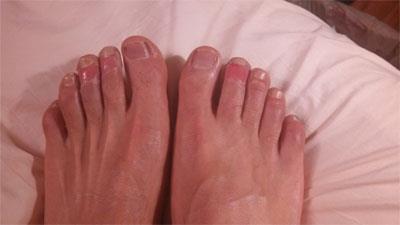 تعرّف على أعراض مرض 