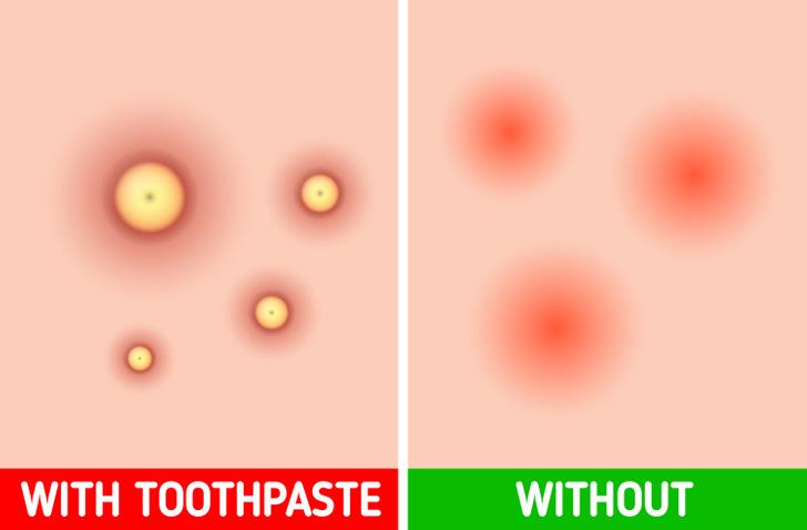 -معجون الأسنان لمعالجة البثور -معجون الأسنان لمعالجة البثور