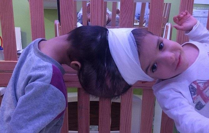 إجراء إحدى أصعب العمليات السيامية بفصل التوأم 