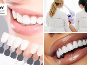 3 tandenbleekbehandelingen (20 min) + evt. polijsten of tanddiamant