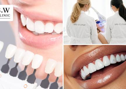 3 tandenbleekbehandelingen (20 min) + evt. polijsten of tanddiamant