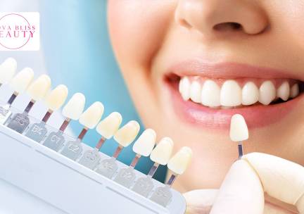 Tandenbleekbehandeling(en) (20 min)