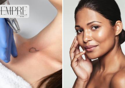 Chemische peeling of tattoo verwijderen