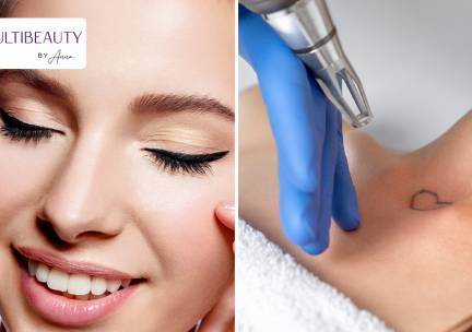 PMU naar keuze laten zetten of PMU of tatoeage laten verwijderen