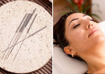 Beauty balance-acupunctuurbehandeling naar keuze (50 of 100 min)