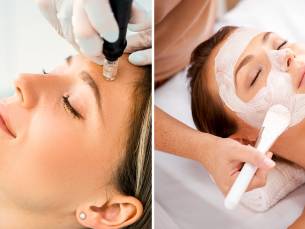 Microneedling, chemical peeling of enzympeeling (30 of 60 min)