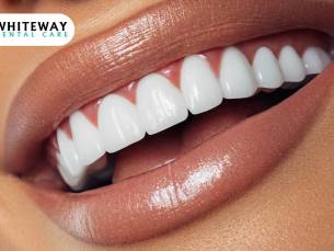 1, 3, 5, 10 of 15 tandenbleekbehandeling(en) + polijsten (20 min)