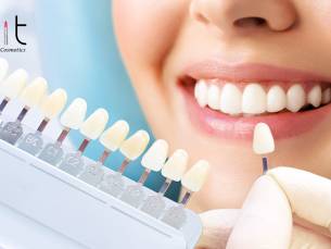 2 tot 6 tandenbleekbehandeling(en)