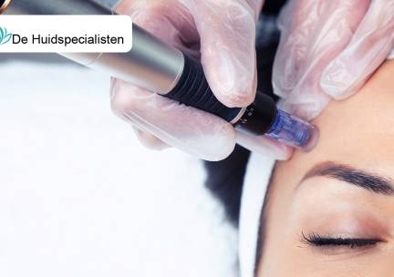 1, 4 of 6 basis of luxe microneedling-behandeling(en)