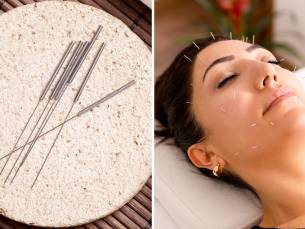 Acupunctuurbehandeling naar keuze (50 of 100 min)