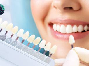 Tandenbleekbehandeling(en) (20 min)