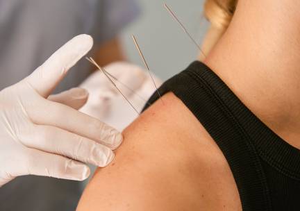 Acupunctuurbehandeling (45 min)