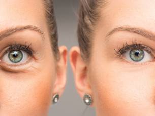 HIFU facelift-behandeling voor zone naar keuze