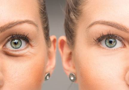 HIFU facelift-behandeling voor zone naar keuze