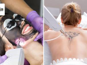 Carbon peeling voor een zone naar keuze of tatoeage verwijderen (tot 35 cm)