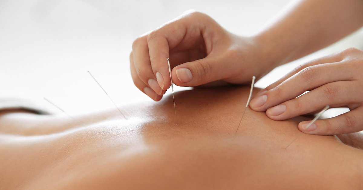 Acupuncture