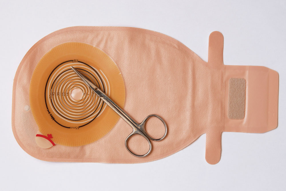 Patients’ experiences of treatment and care after ileostomy Nursing Times