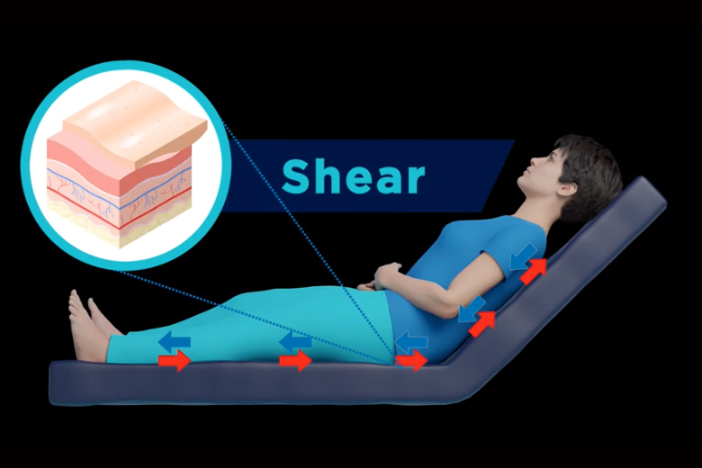 Video 1 The fundamentals of the science of support surfaces Nursing