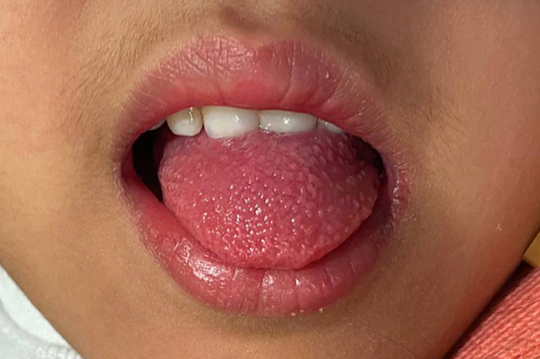 Early recognition and management of group A streptococcus infection