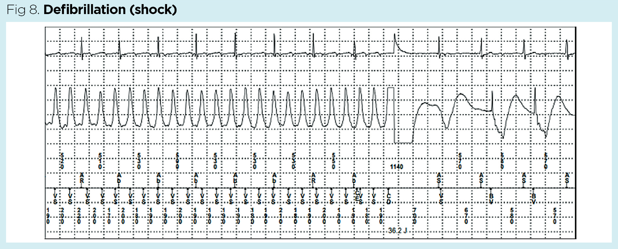 Complex cardiac device therapy 1 implantable cardioverter