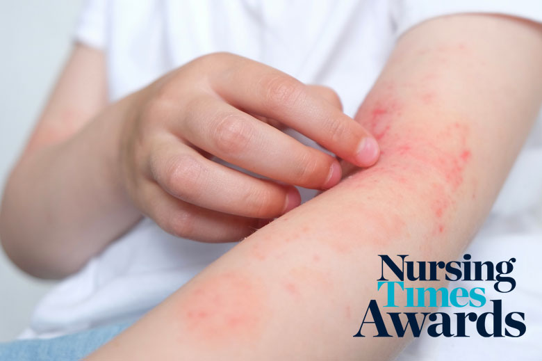 Developing a nurse-led allergy service to improve access to expert care - Vimarsana News