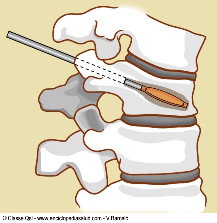 Cifoplastia para tratar fracturas en la columna vertebral