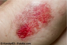 D abrasion