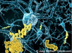 D alzheimer2